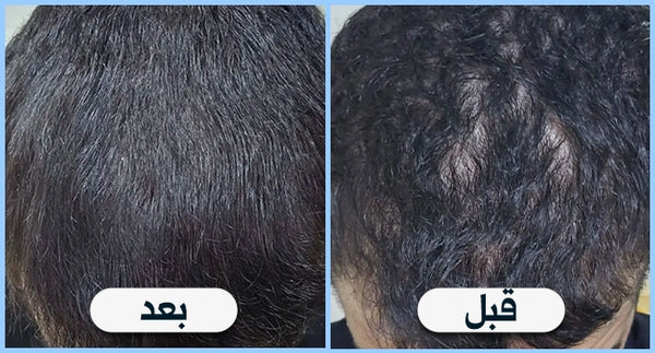 قبل وبعد — كثافة فروة الرأس