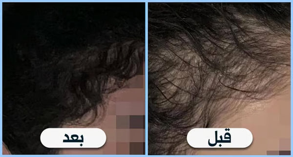 قبل وبعد — كثافة مقدمة الرأس